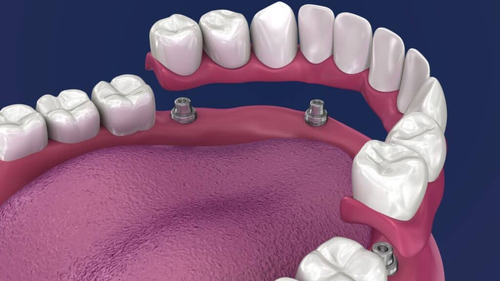 All on 4 dental implant representation