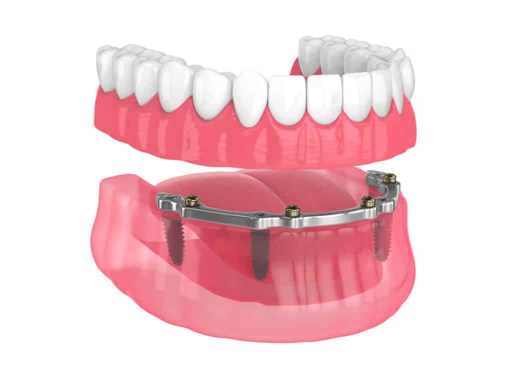 Implant dentures