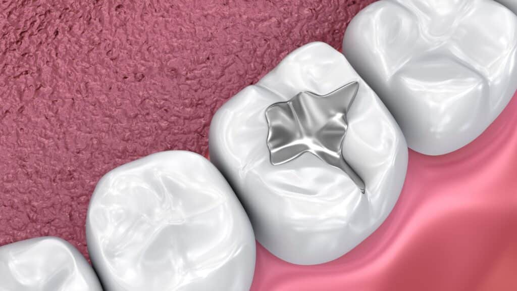 Dental sealant example