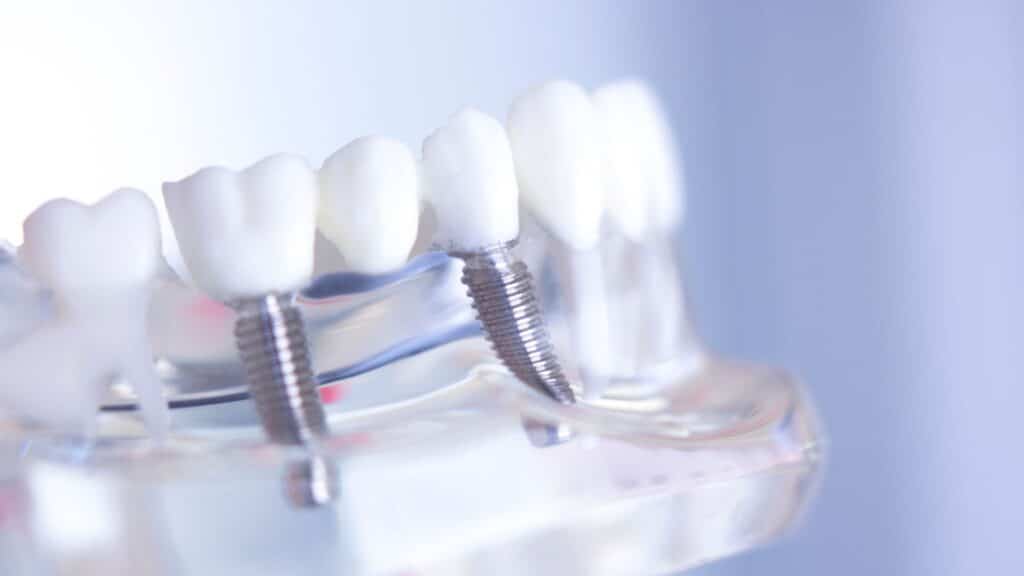 Dental implant support bridge example