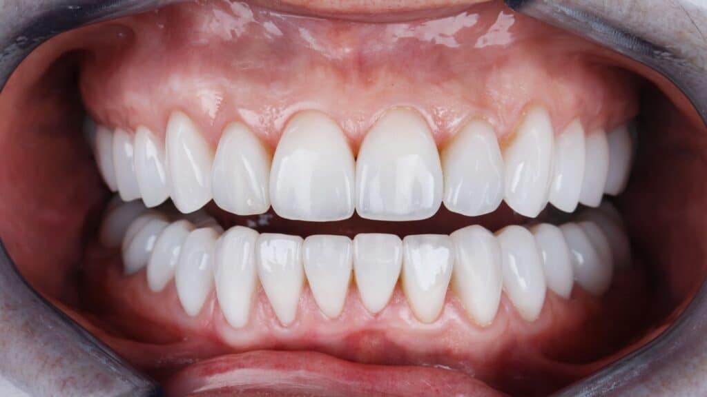 Teeth with porcelain veneers