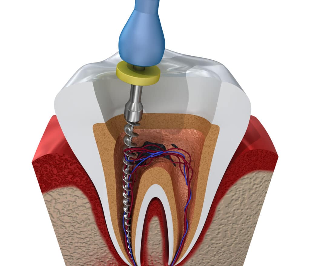 Root canal treatment representation