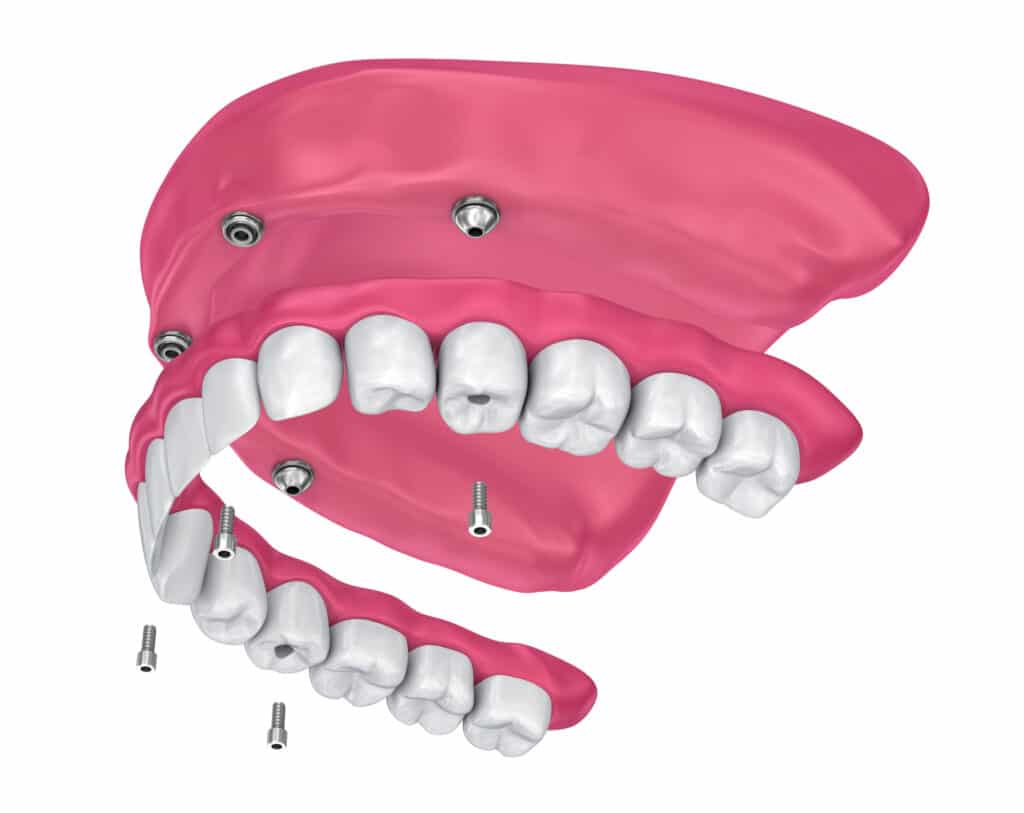 Screw retained dentures