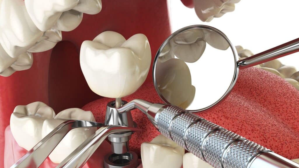 Dental implant procedure representation