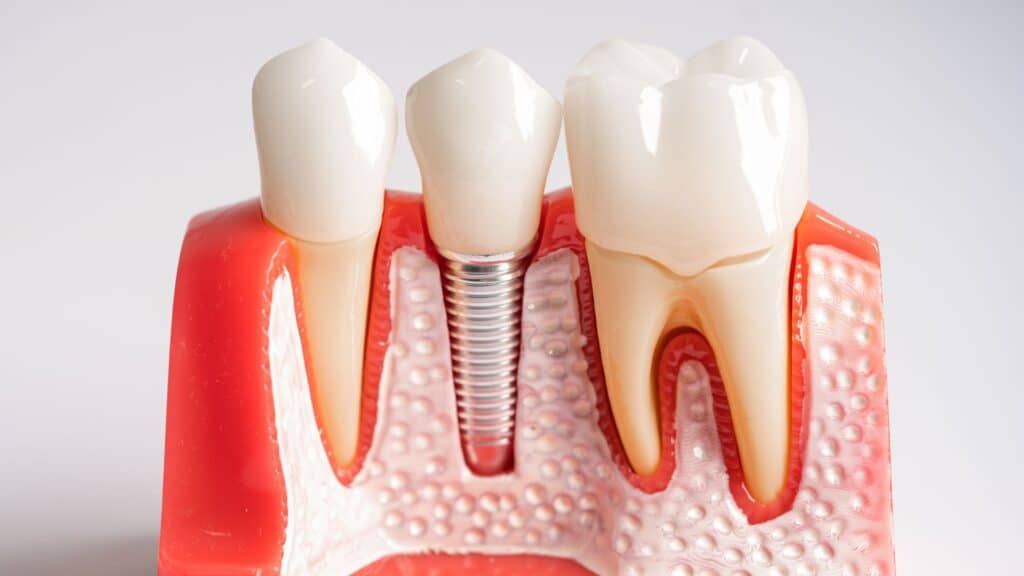 Single dental implant representation