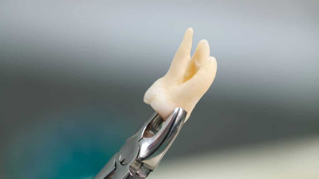 Tooth extraction example