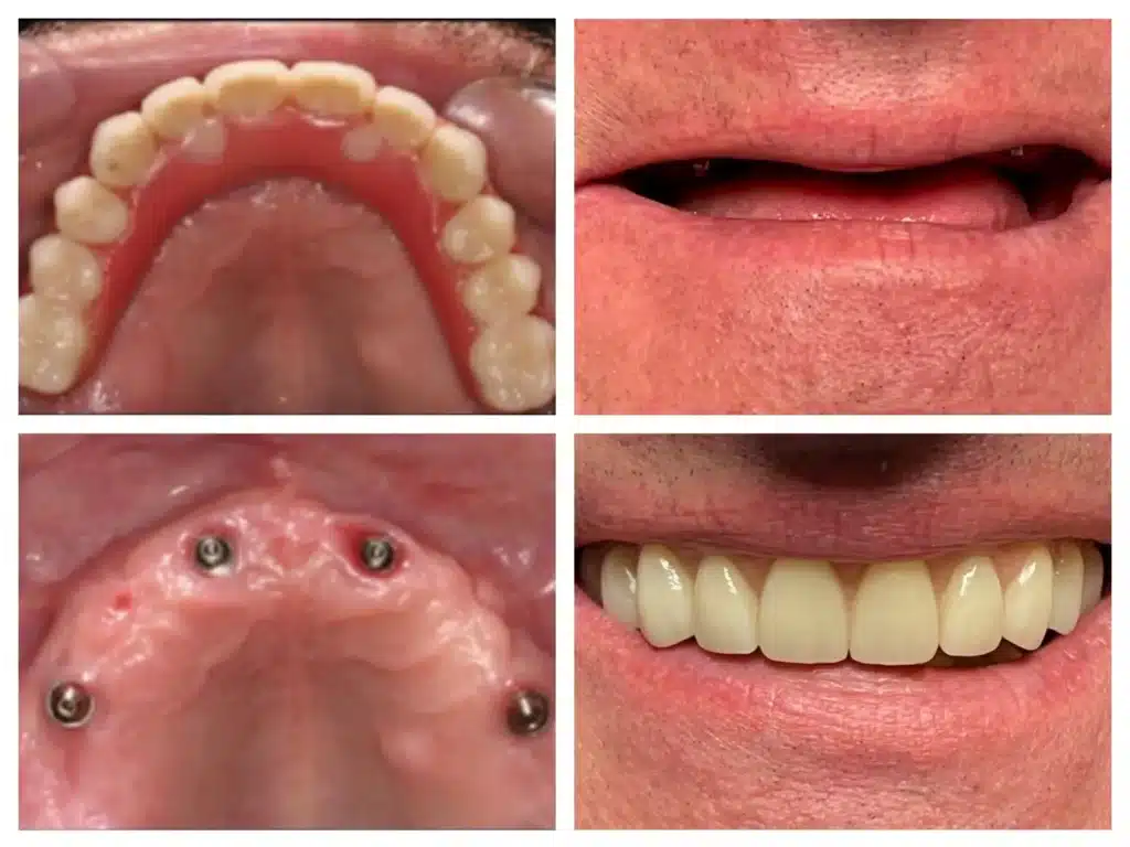 Dental implants before and after