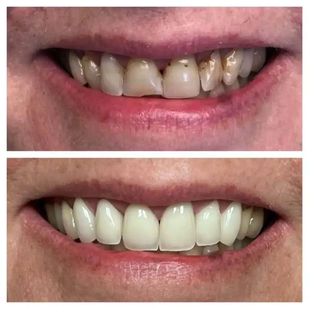 Dental crowns before and after