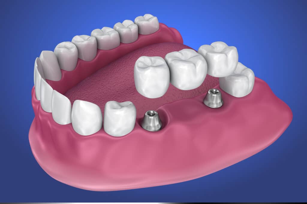 implant supported fixed bridge. Medically accurate 3D illustration