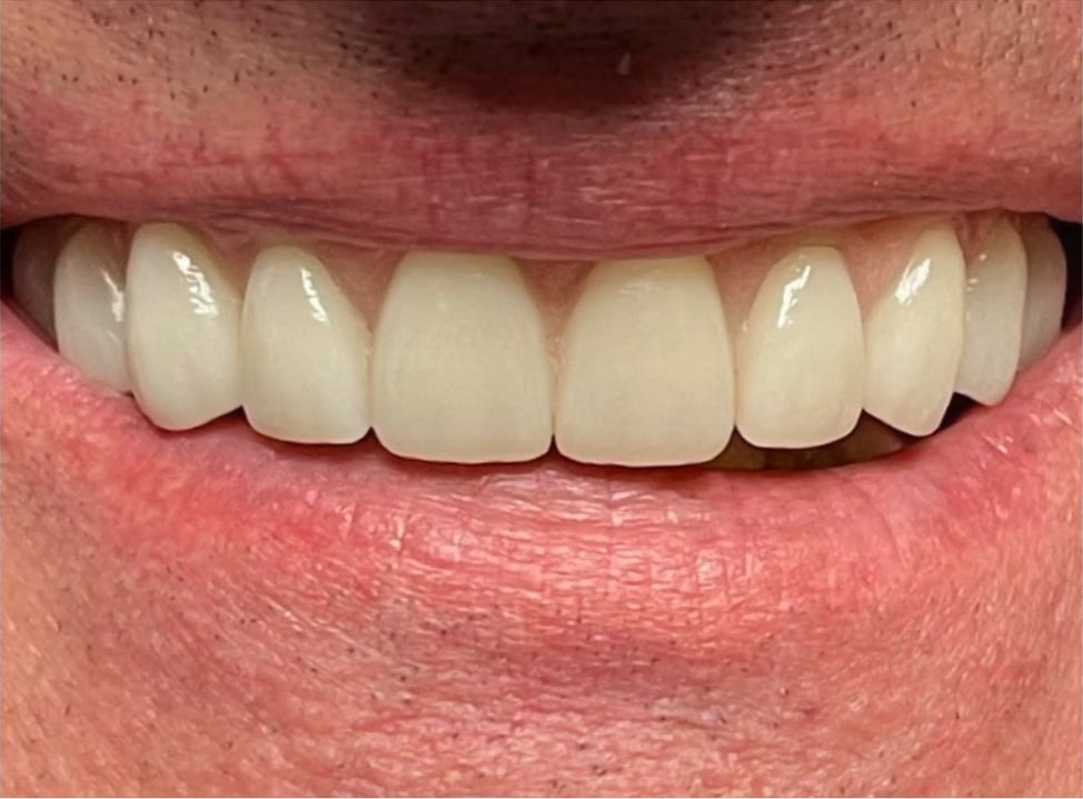 Prothesis attached to dental implants