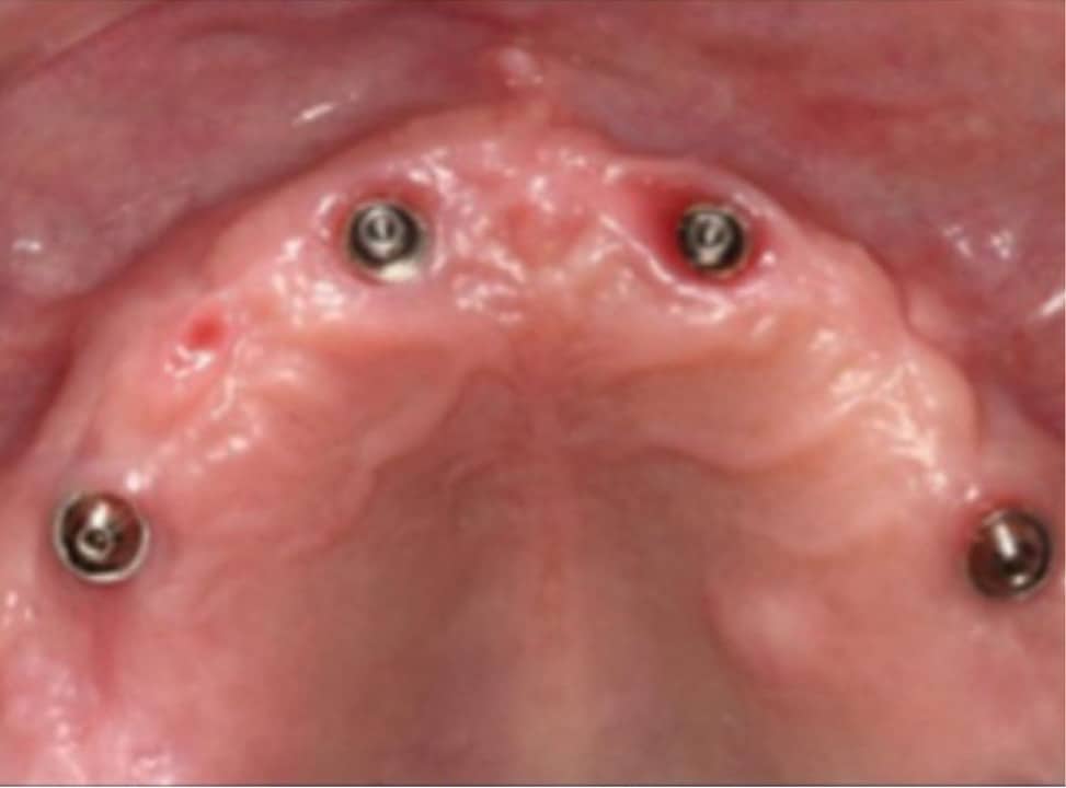 Dental Implants arch