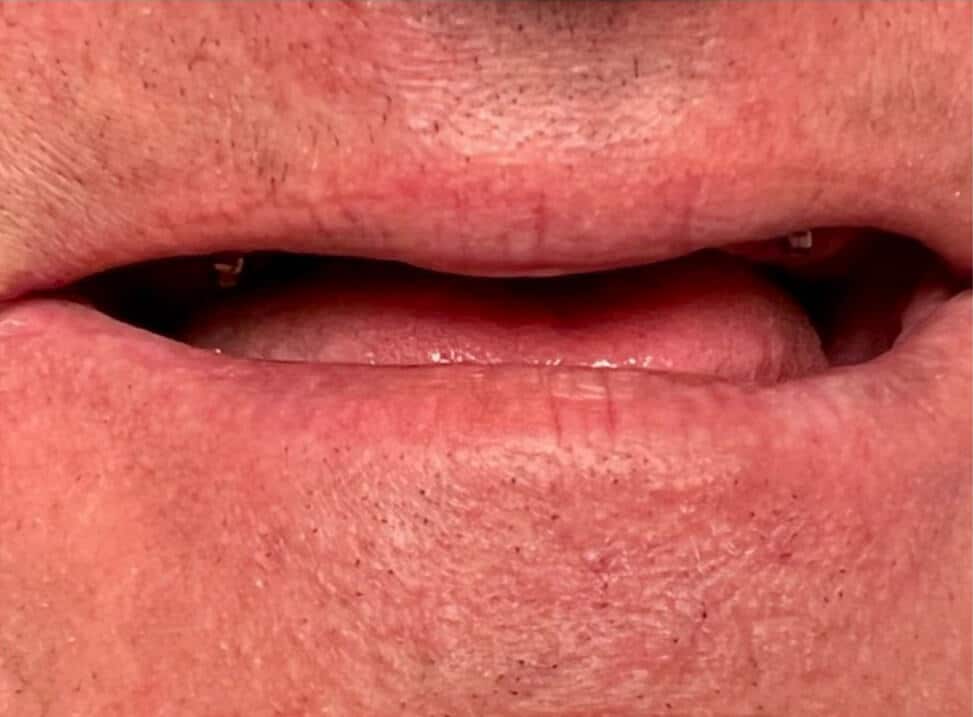 Implants smile before crowns placed