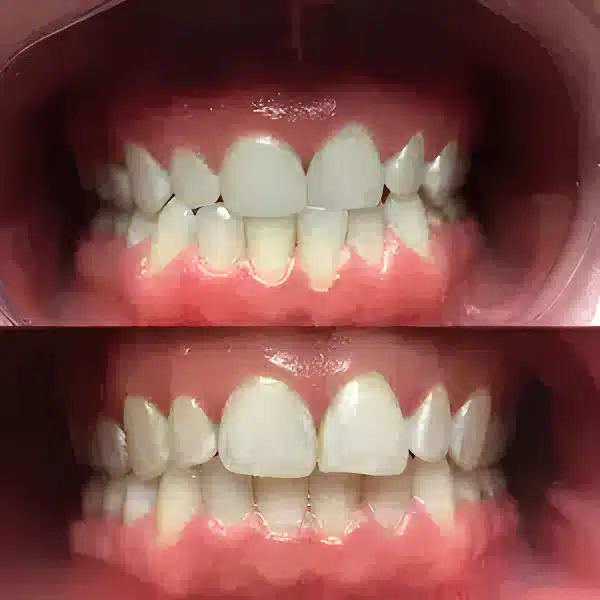 Before and after Invisalign dental treatment from Arlington Family and Cosmetic Dental Associates