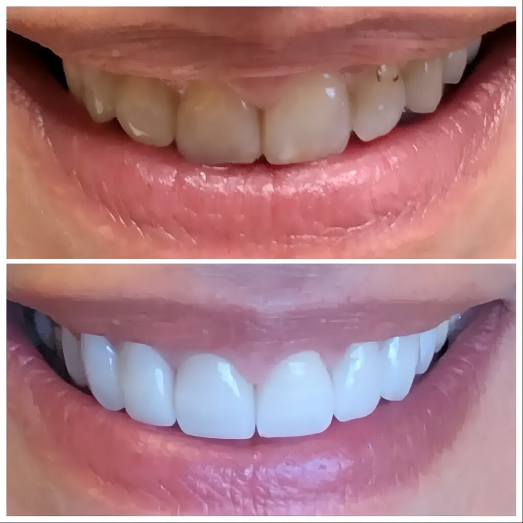 Before and after