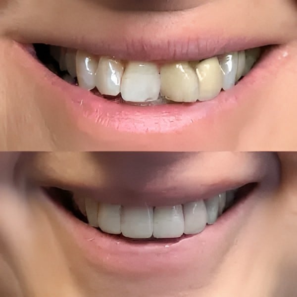 Before and after