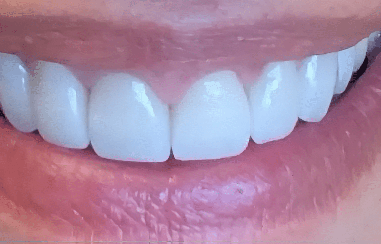 Smile gallery after