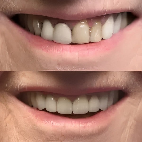 Before and after