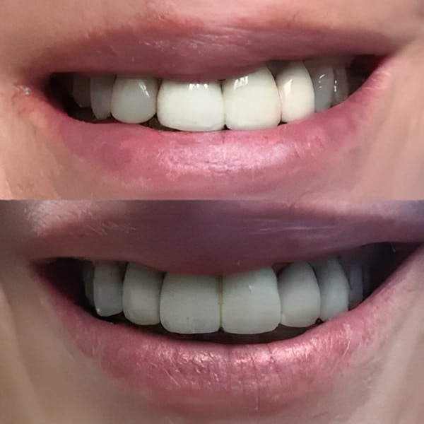 Before and after