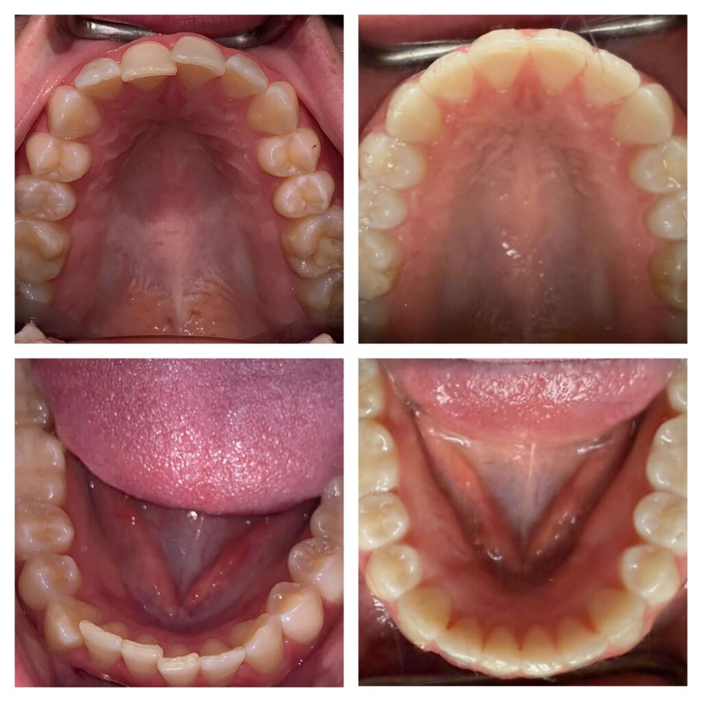 Before & after Invisalign orthodontic treatment